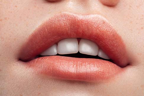 Image of beautiful woman with dermal filler enhanced lips.