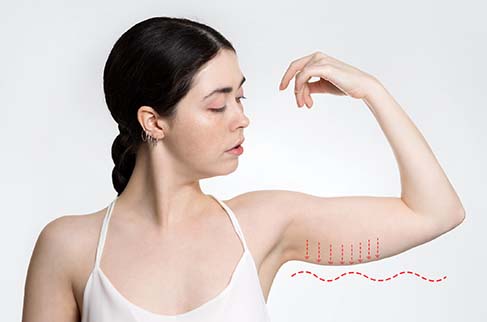White Mountain med spa offers body sculpting to help with arm sagging as shown here.