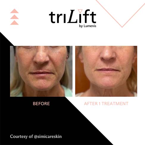 White Mountain Med Spa in New Hampshire offers triLift, which is the first ever treatment that tones, defines, and contours your facial muscles.