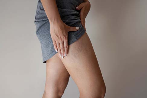 White Mountain Med Spa offers sclerotherapy to treat spider veins such as those shown here.